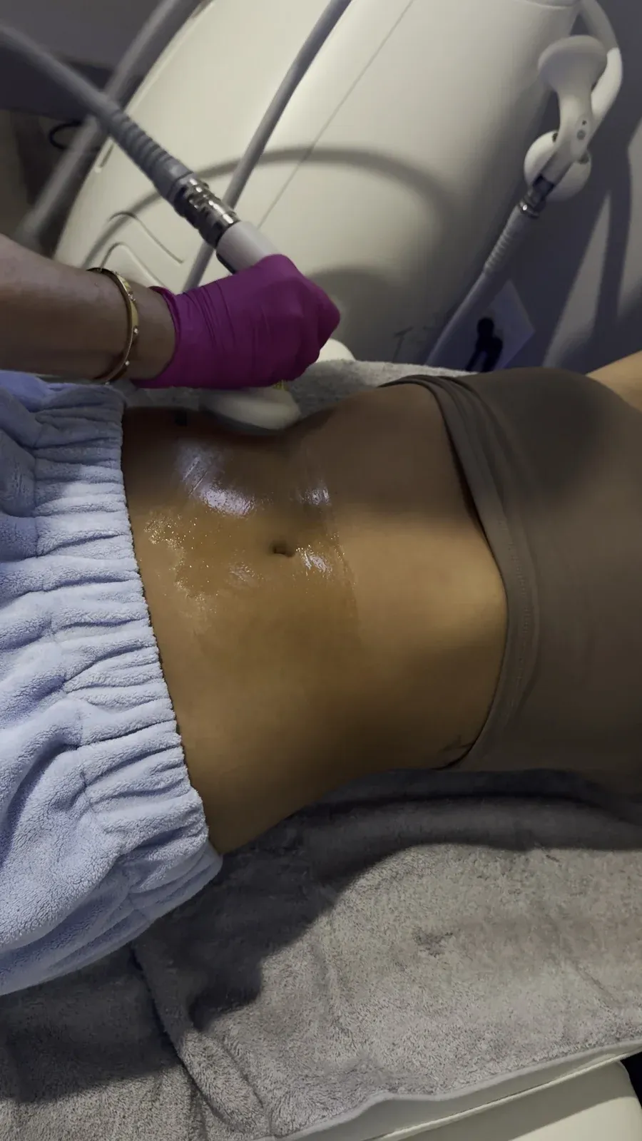 T-Shape body treatment with the clinic’s white applicator on the abdomen.